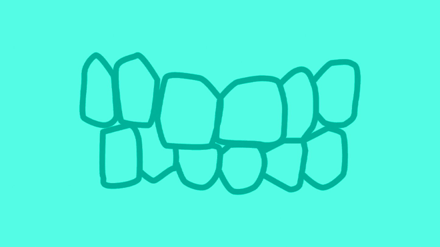 Clear Aligners