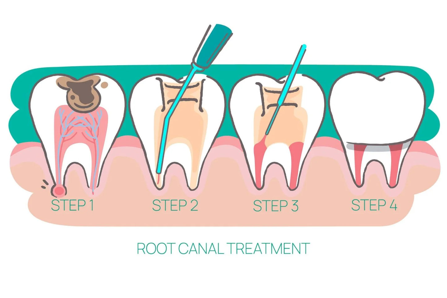 Root Canal