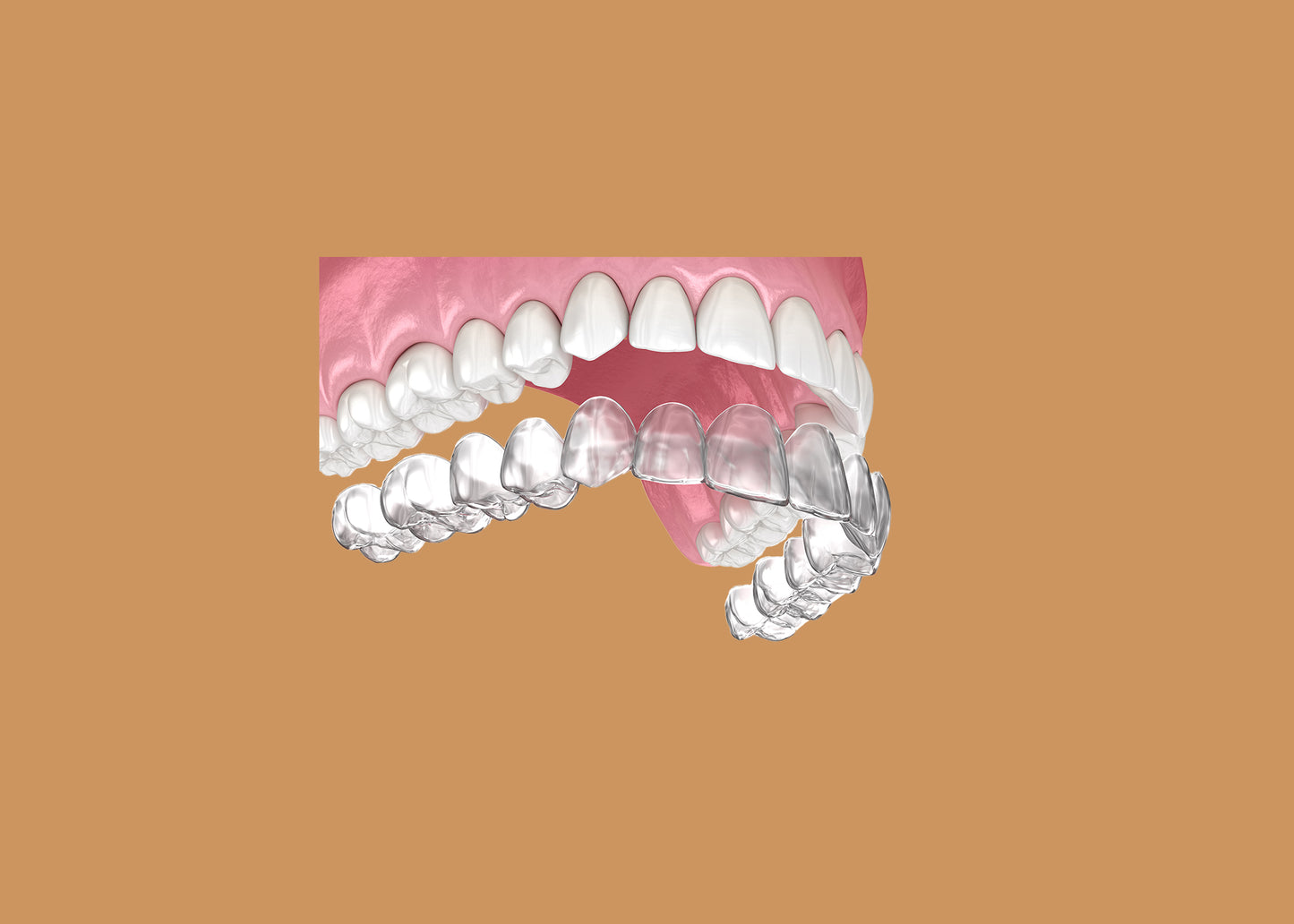 Clear Aligners