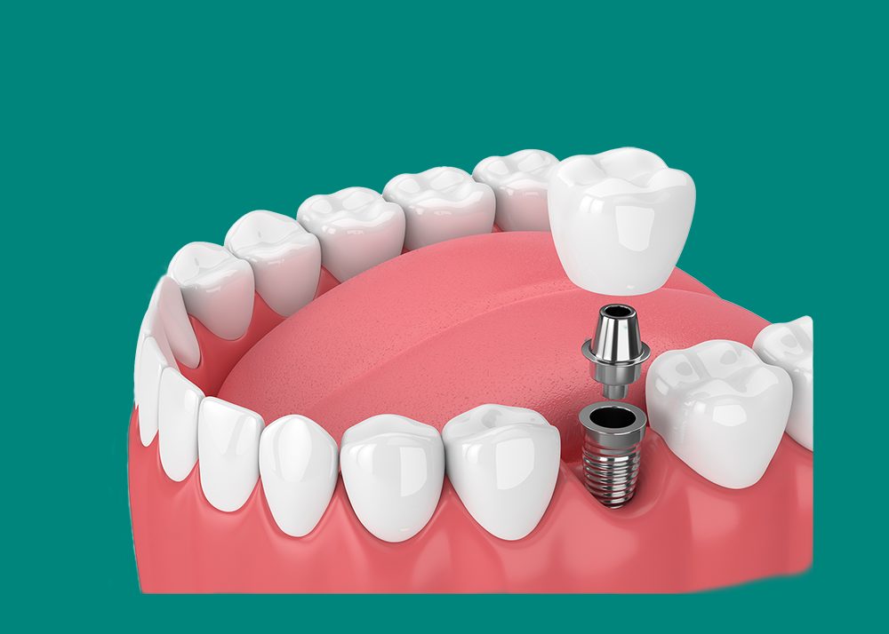 Dental Implant